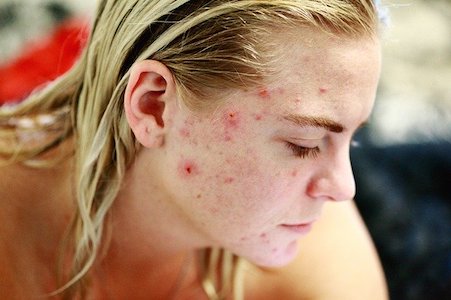 Healing Acne Naturally