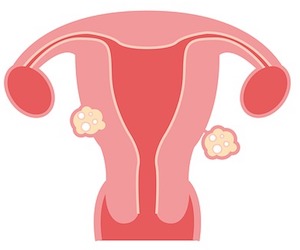 shrinking uterine fibroids