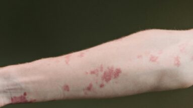 treating eczema naturally
